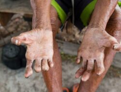 Bahaya Kusta Mengintai Kendari: 25 Kasus Baru dalam Setahun