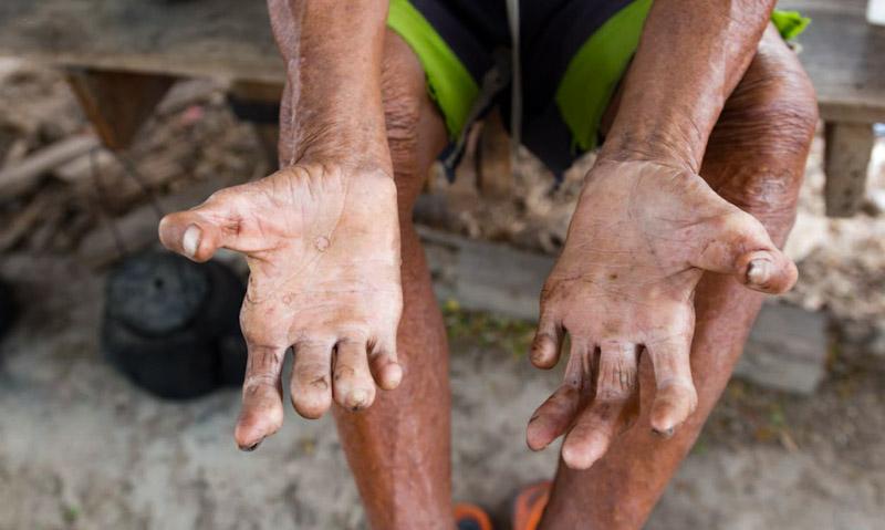 Bahaya Kusta Mengintai Kendari: 25 Kasus Baru dalam Setahun 1 Bahaya Kusta Mengintai Kendari: 25 Kasus Baru dalam Setahun